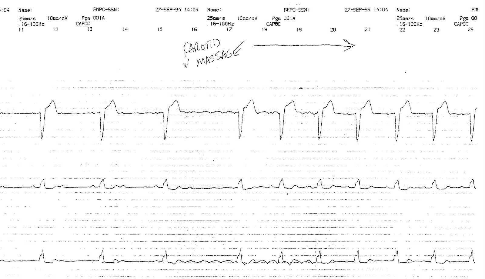 ekg with pacemaker