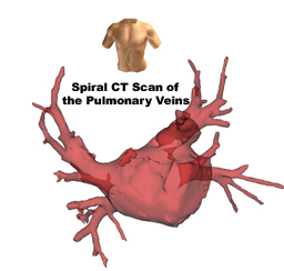 Spiral CT image of left atrium obtained pre-procedure